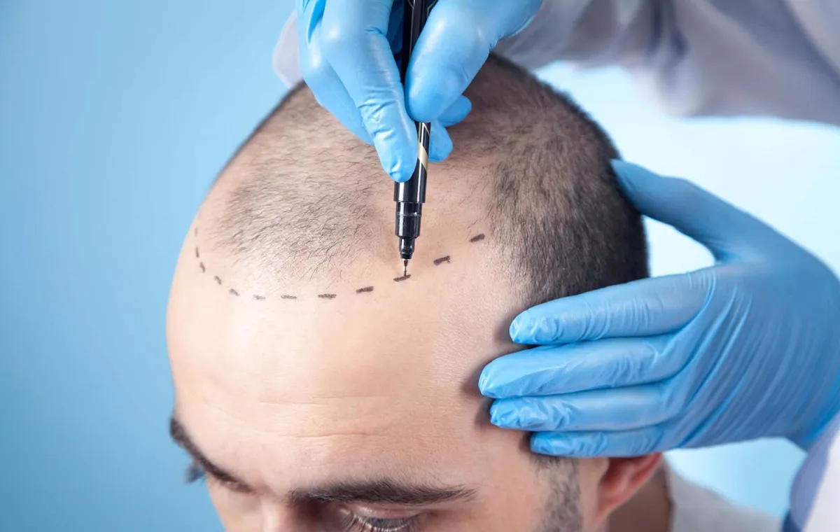 مراقبت‌های قبل و بعد از کاشت مو