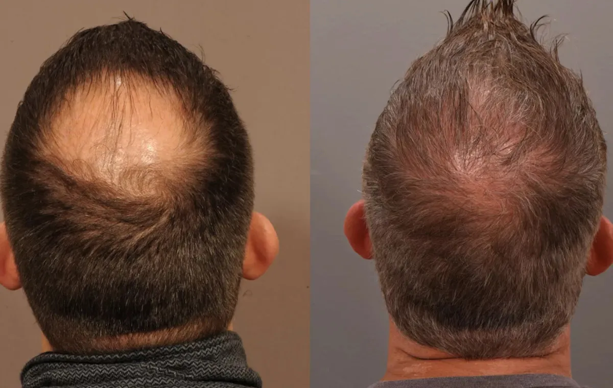 مراقبت‌های بعد از کاشت مو