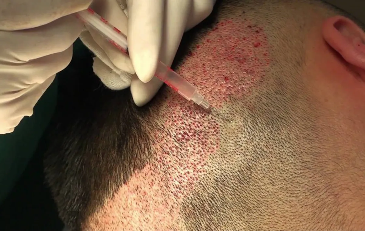 مراقبت‌های قبل و بعد از کاشت مو