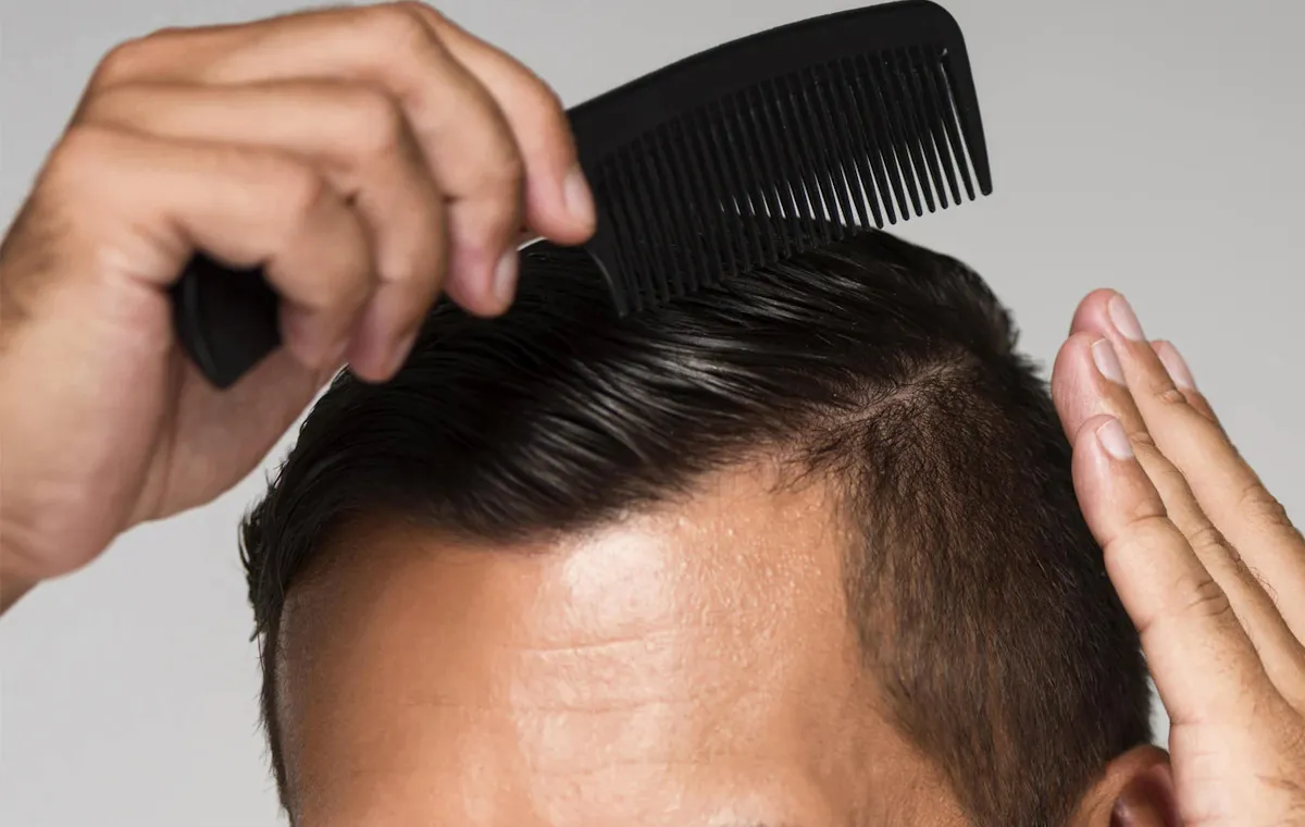 عمل کاشت مو