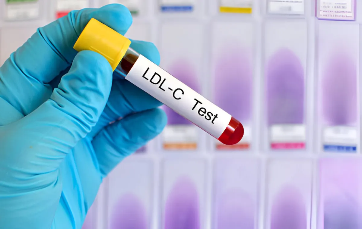 کاهش کلسترول بد با خوردن لوبیا چیتی