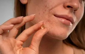 آیا قرص استامینوفن برای جوش صورت مفید است؟