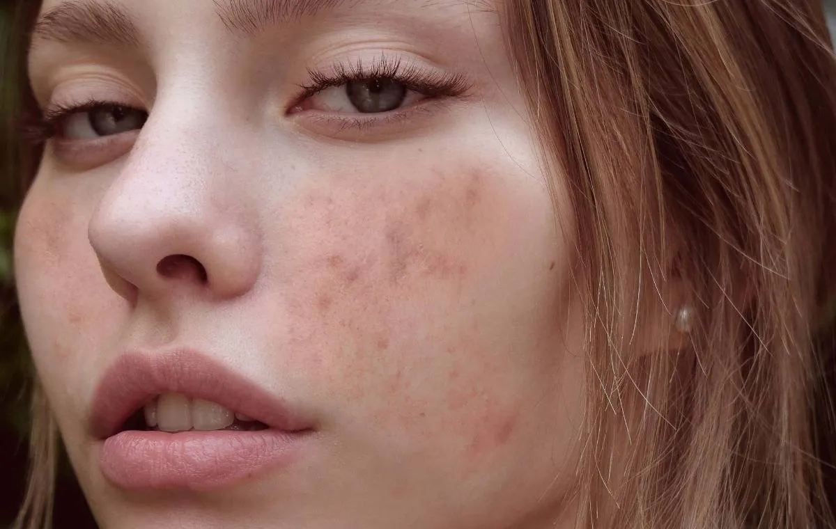 بهترین درمان لک ملاسما 