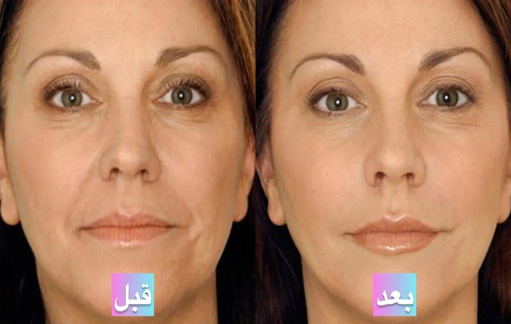 عکس قبل و بعد از پی آر پی صورت؛ مقایسه تاثیرات درمان و مزایا • دیجی‌کالا مگ