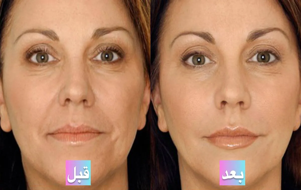 عکس قبل و بعد پی آر پی برای افتادگی پوست