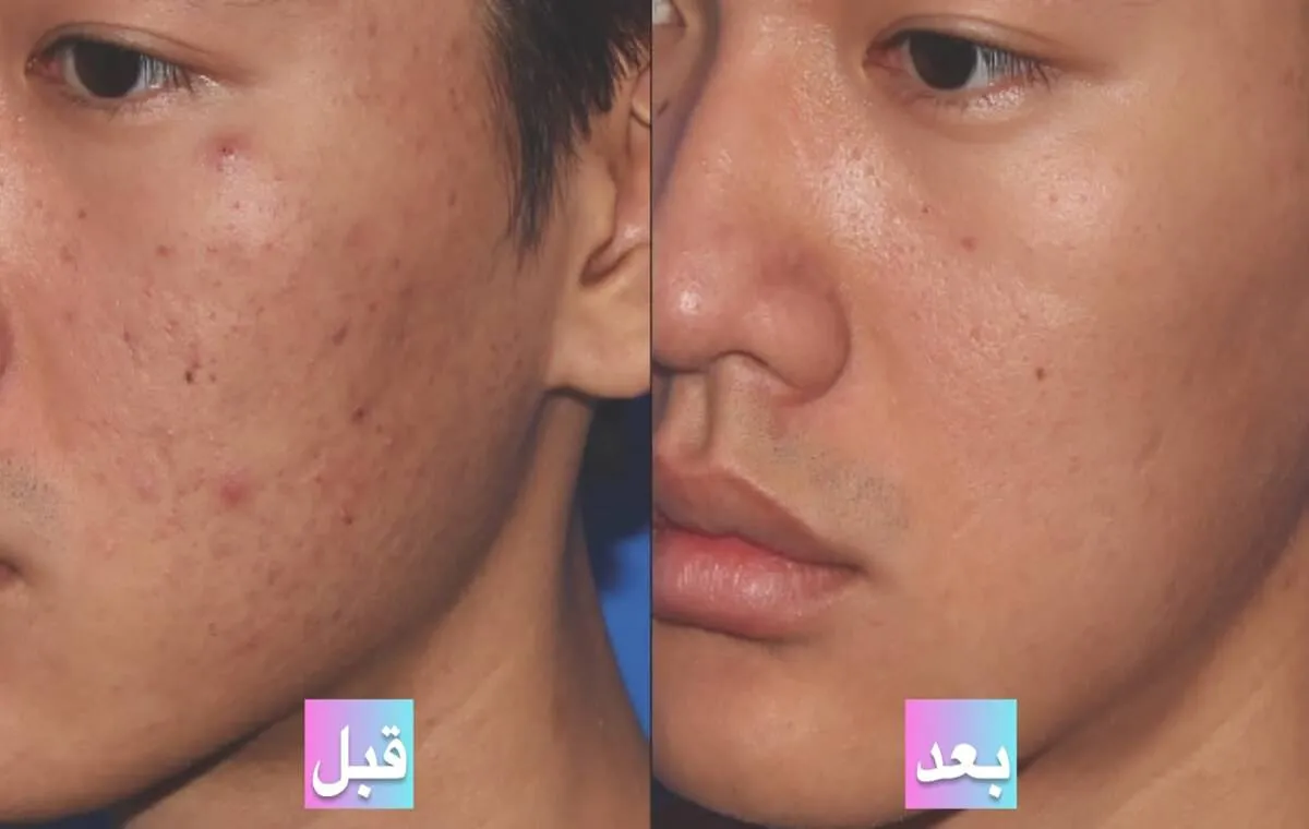 عکس قبل و بعد از پی آر پی صورت