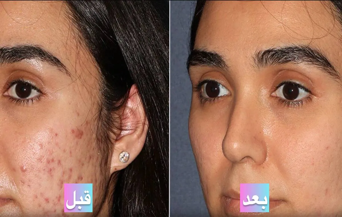 عکس قبل و بعد از پی آر پی صورت