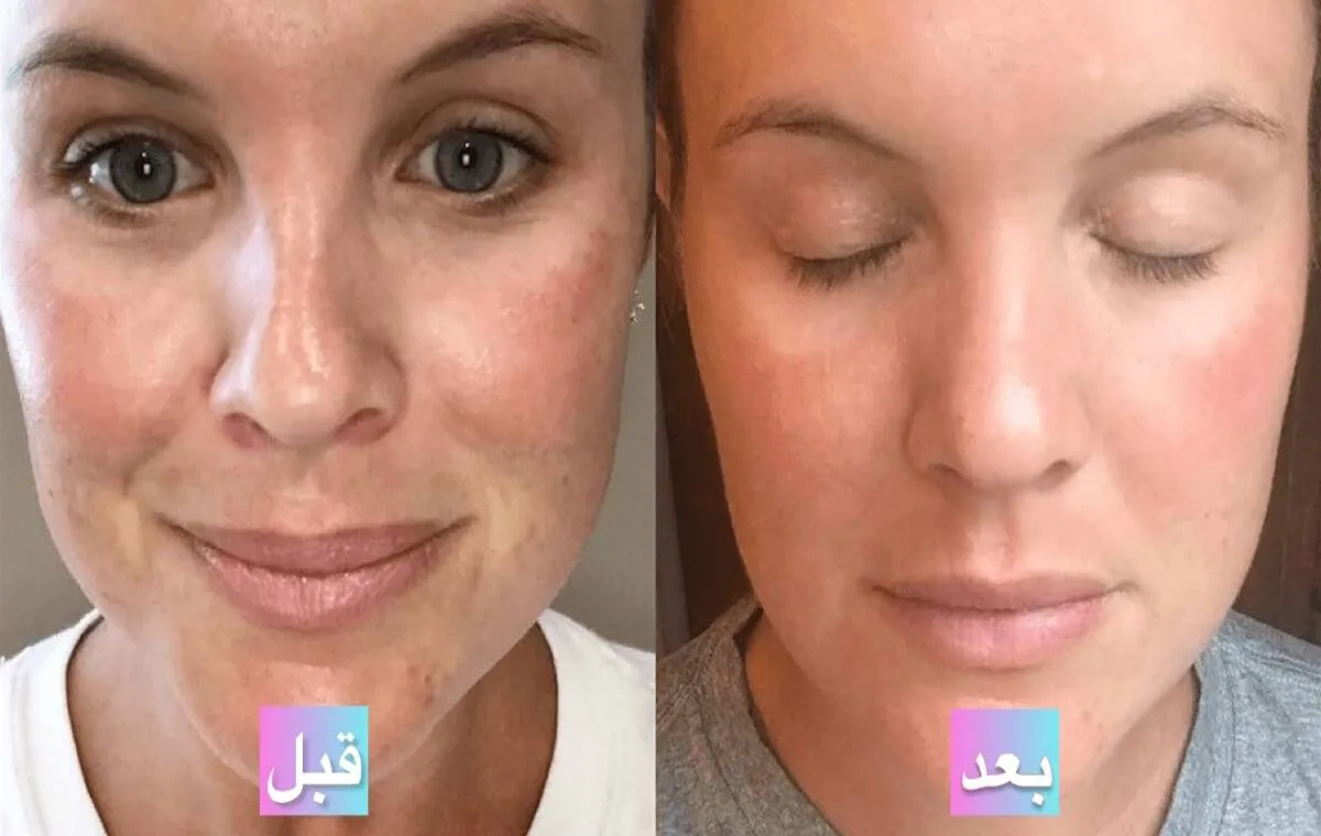 عکس قبل و بعد از پی آر پی صورت برای کاهش لک‌های پوستی