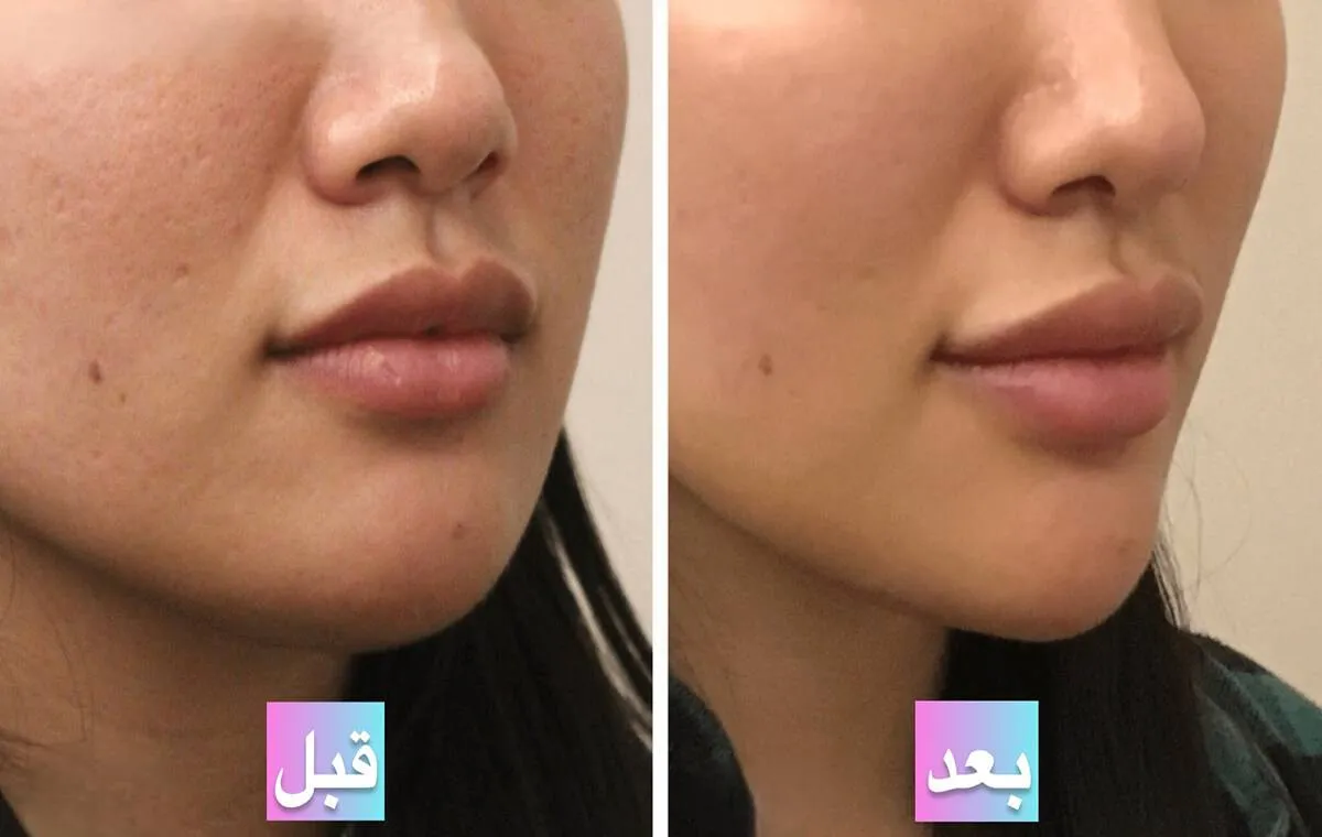 عکس قبل و بعد از پی آر پی صورت برای فرورفتگی جای جوش