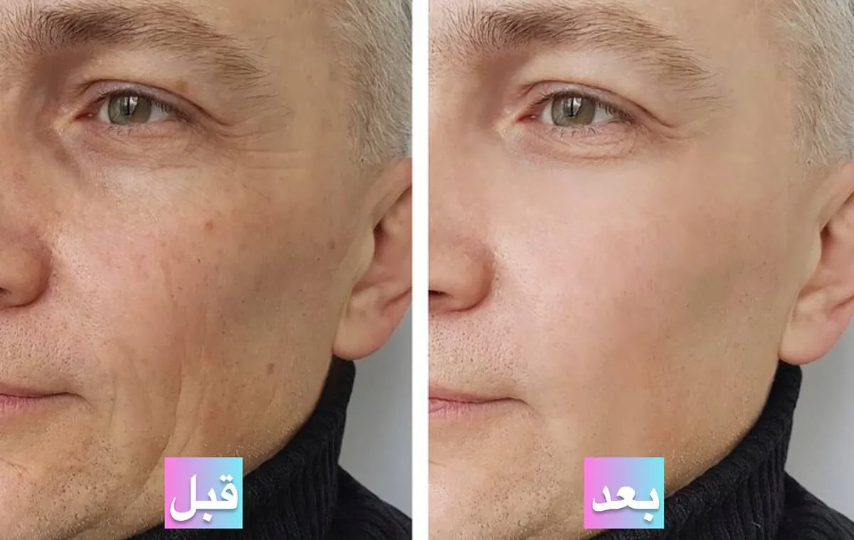 عکس قبل و بعد از پی آر پی صورت برای چین و چروک