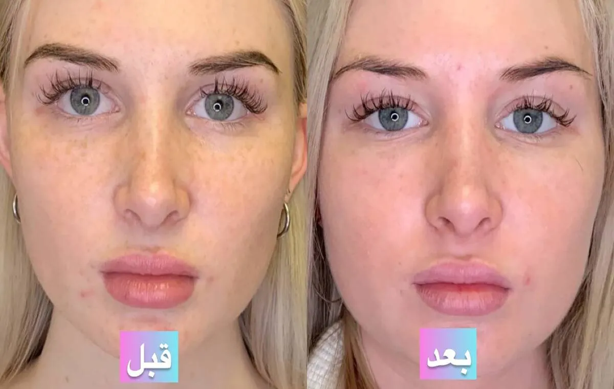 عکس قبل و بعد از پی آر پی صورت برای شاداب شدن پوست