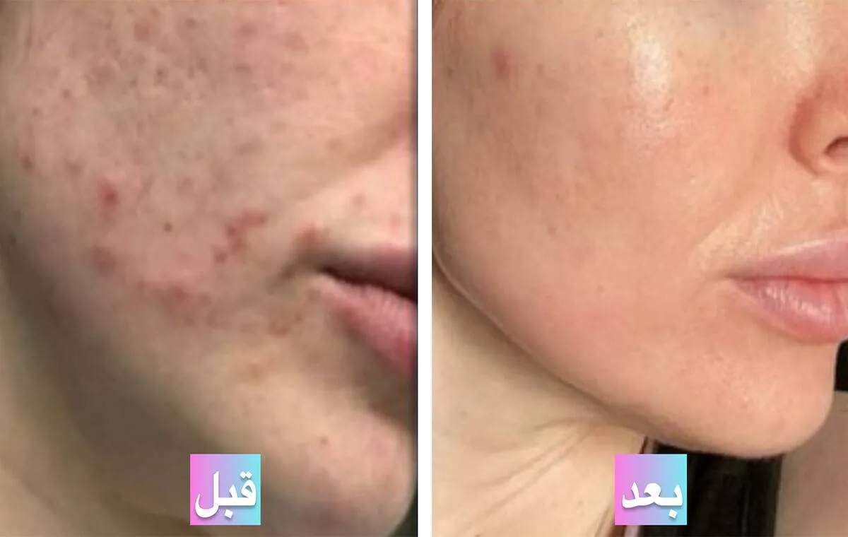 عکس قبل و بعد از پی آر پی صورت برای جوش