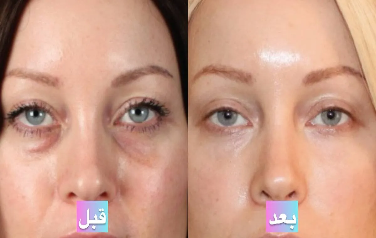 عکس قبل و بعد از پی آر پی زیر چشم