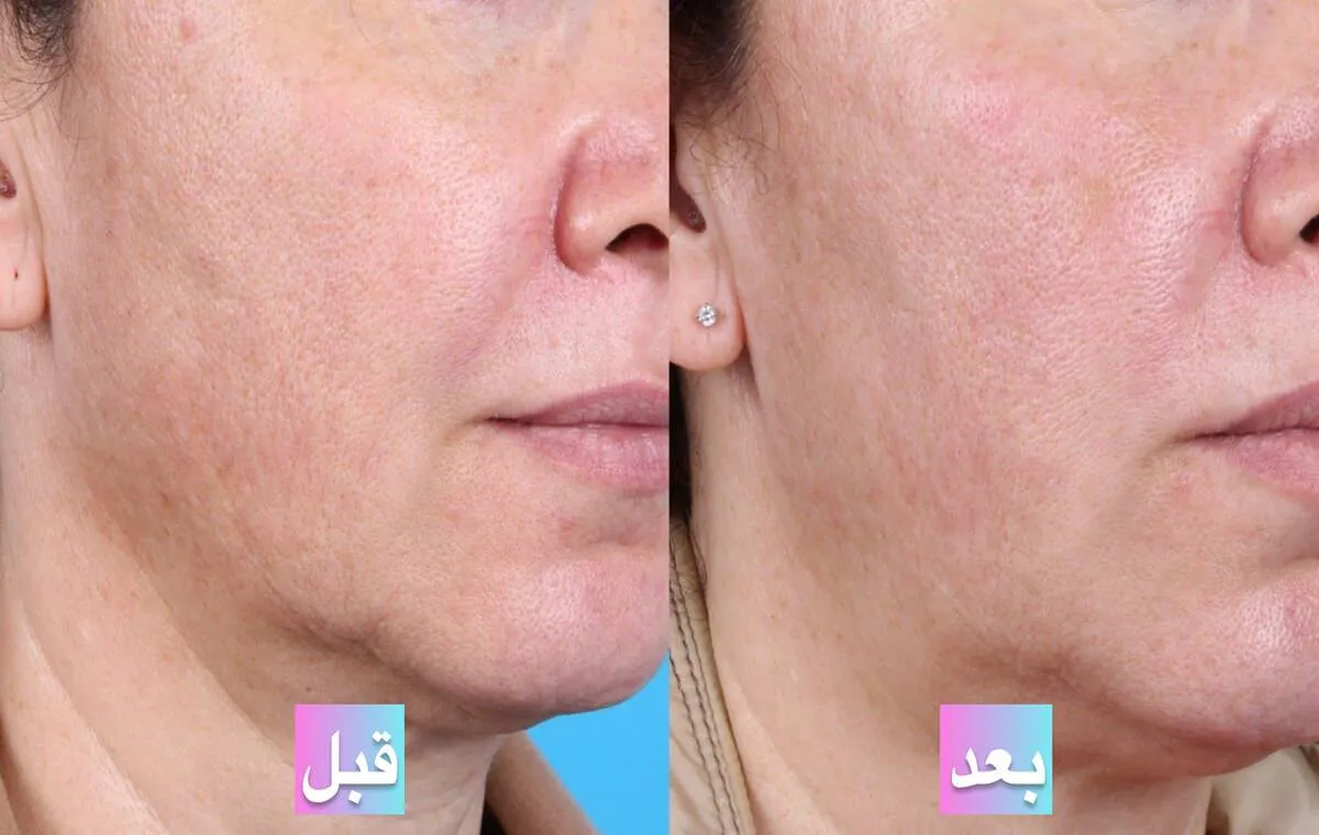 ماندگاری پی آر پی صورت چقدر است؟