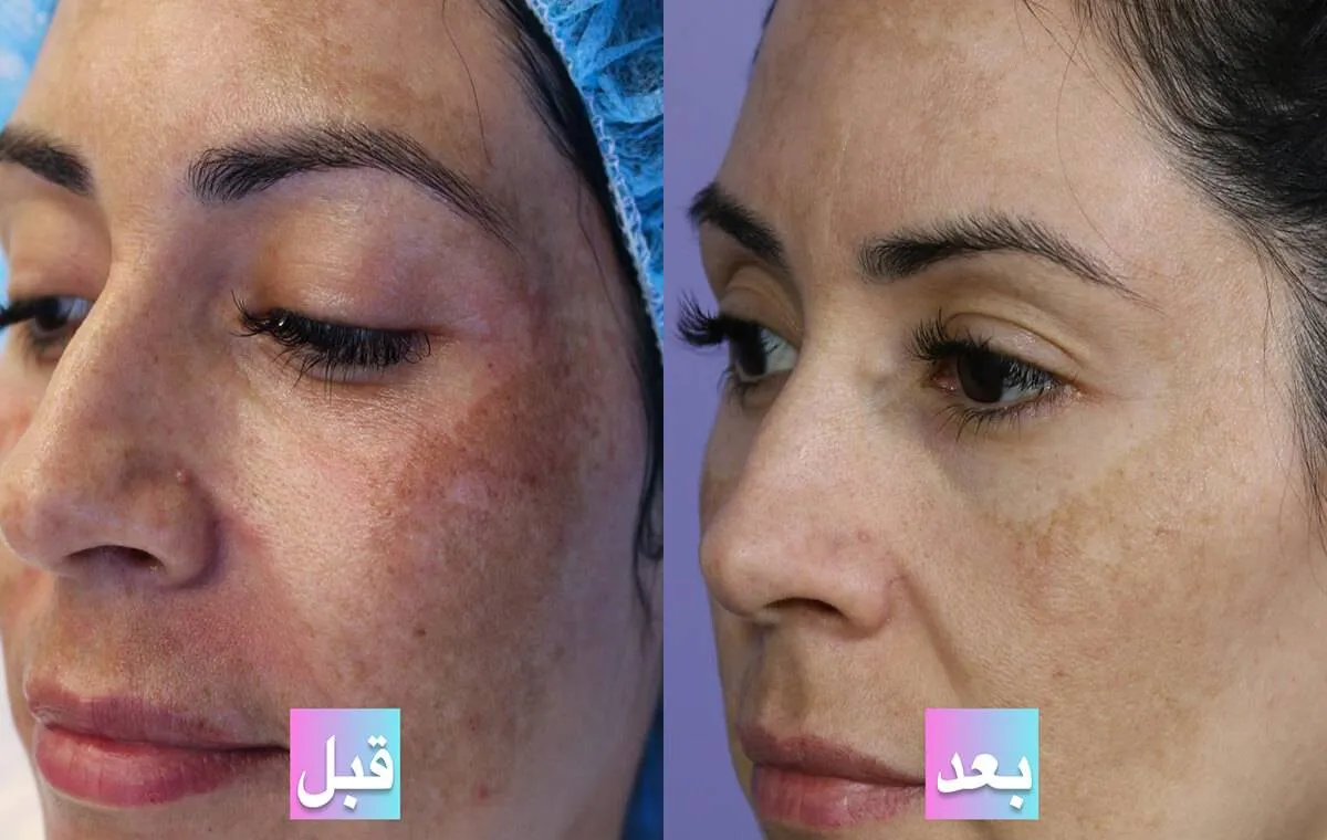 عکس قبل و بعد از پی آر پی صورت برای ملاسما