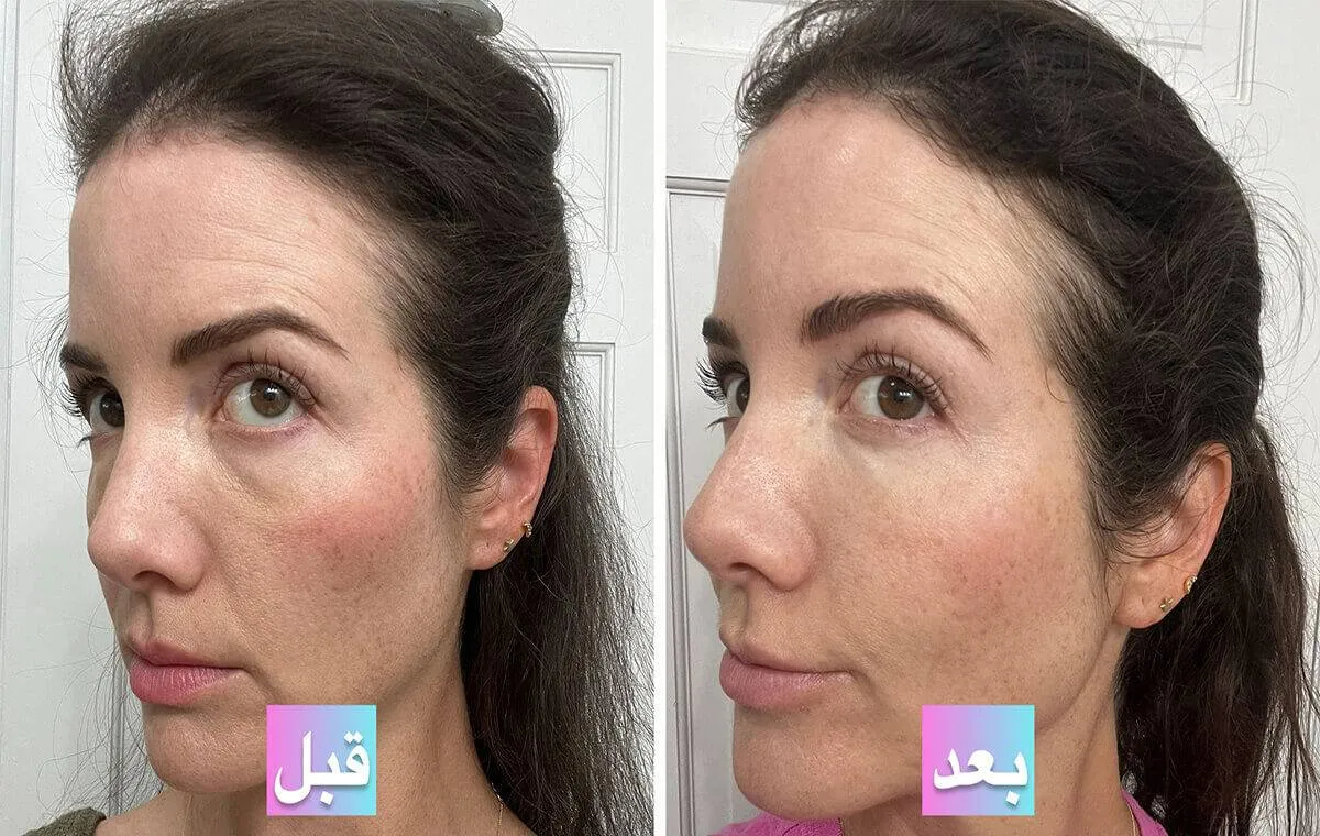 عکس تفاوت قبل و بعد از پی آر پی