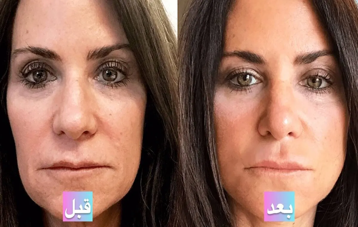 عکس قبل و بعد از پی آر پی صورت