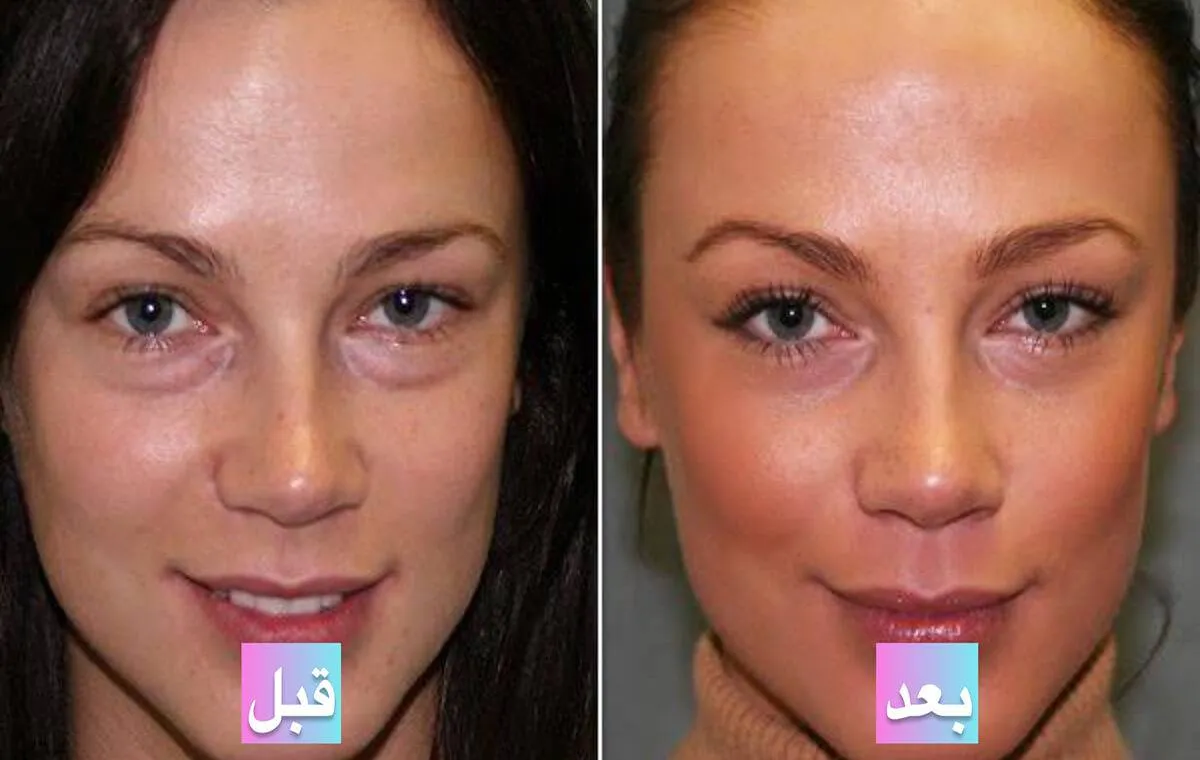 مراقبت‌های پس از انجام عکس قبل و بعد از پی آر پی صورت