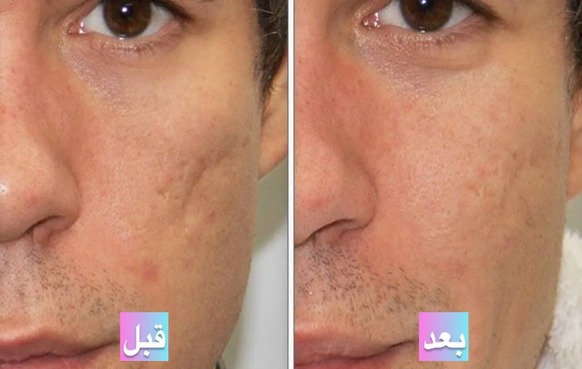 عکس قبل و بعد از پی آر پی صورت