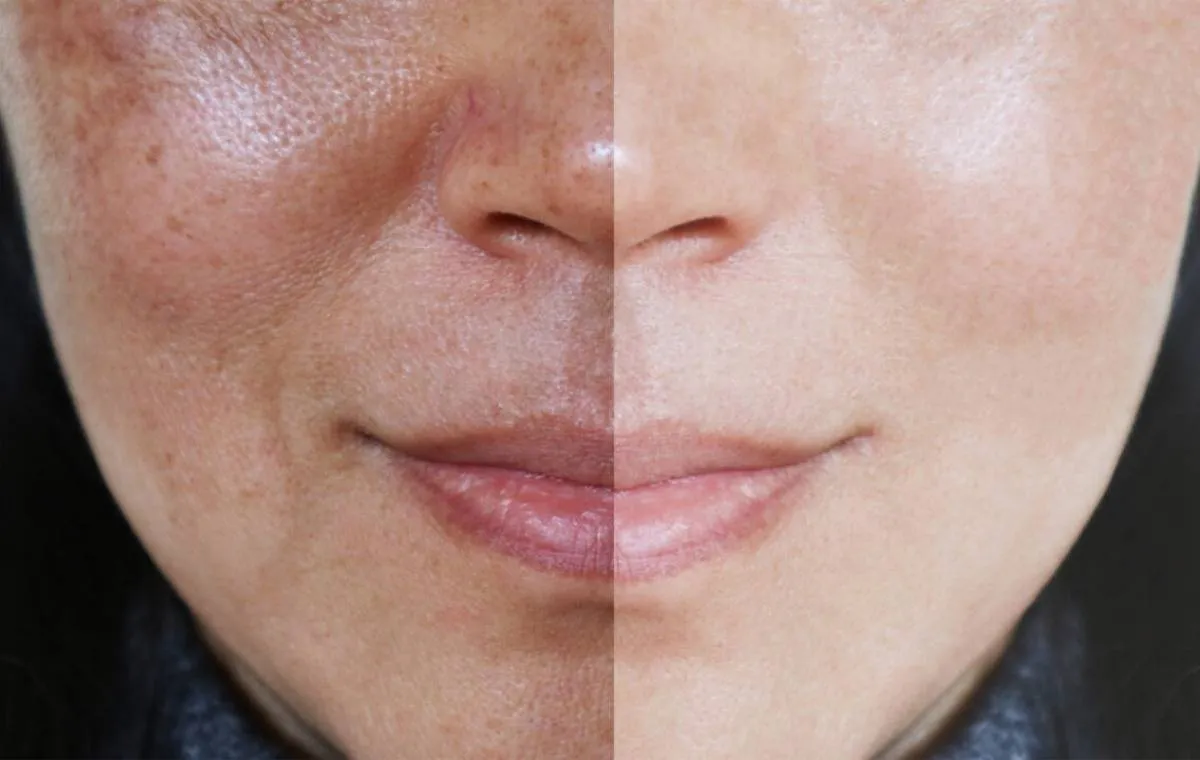 درمان ملاسما قبل و بعد