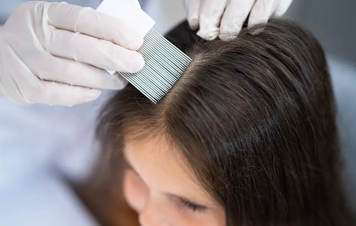 قویترین داروی ضد شپش خانگی؛ راهکارهای ساده و فوری