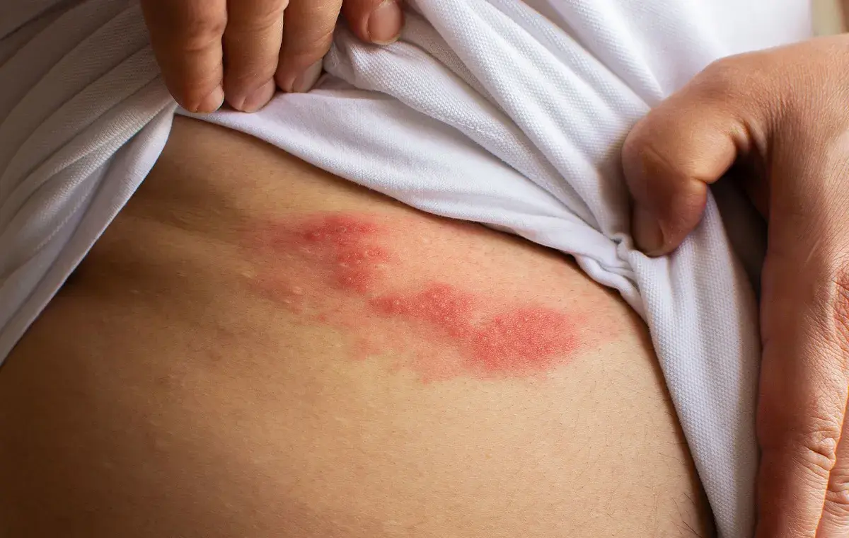 بهترین پماد برای زونا؛ تجربه بیماران و نظر متخصصان