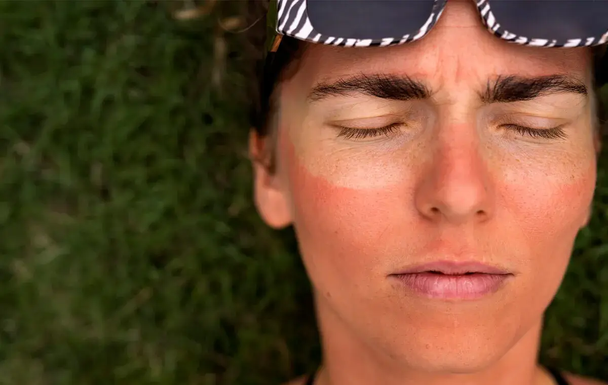 روش‌های سفيد كردن پوست آفتاب سوخته در خانه