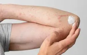 بهترین پماد برای جوش بدن