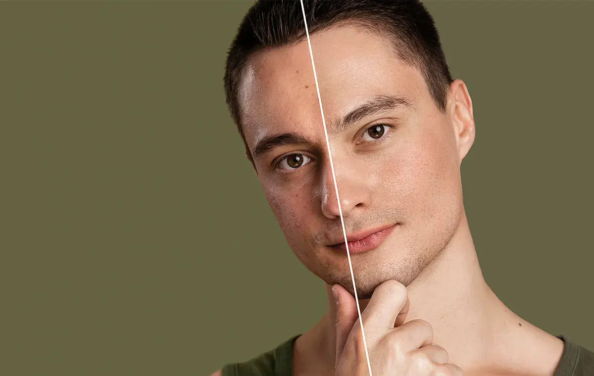 پماد زینک اکساید برای لک صورت