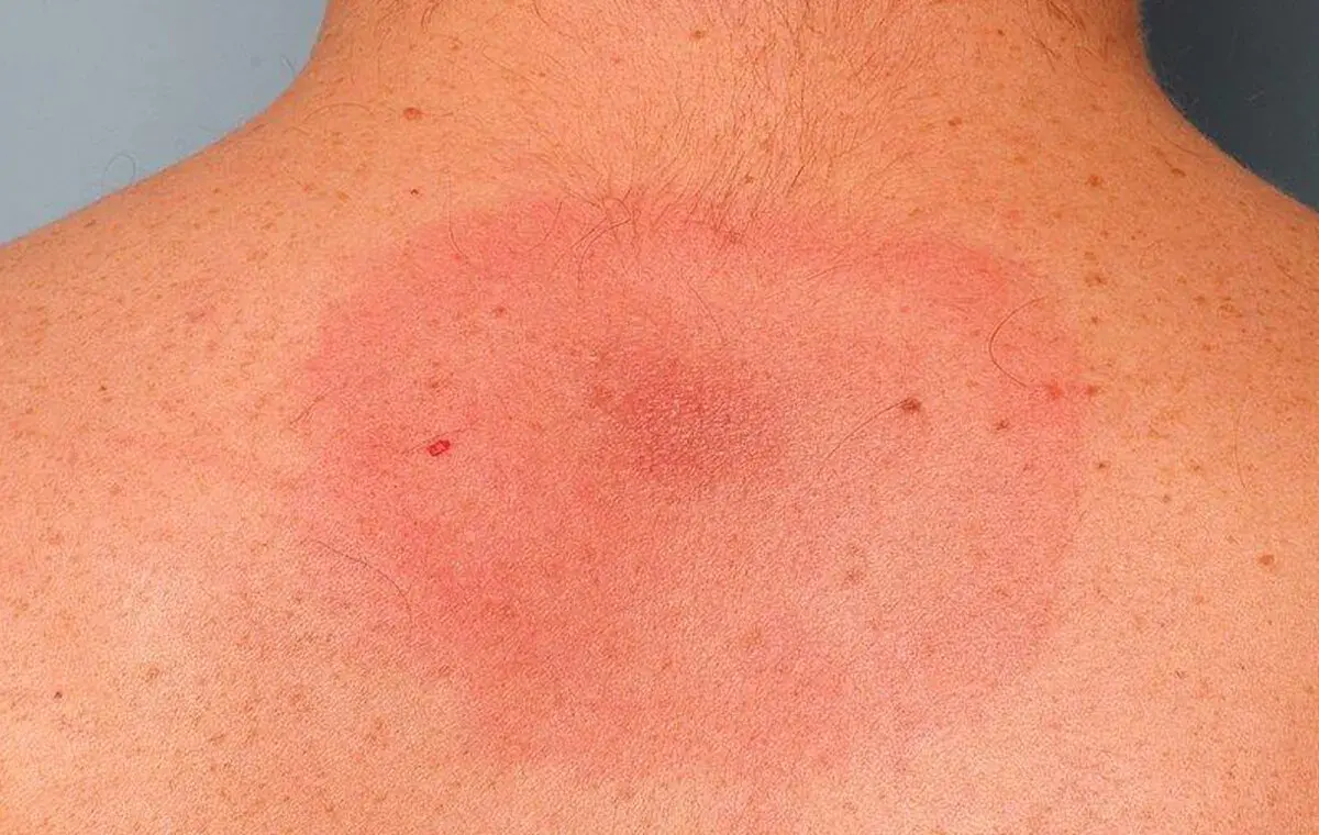 مراحل بیماری لایم