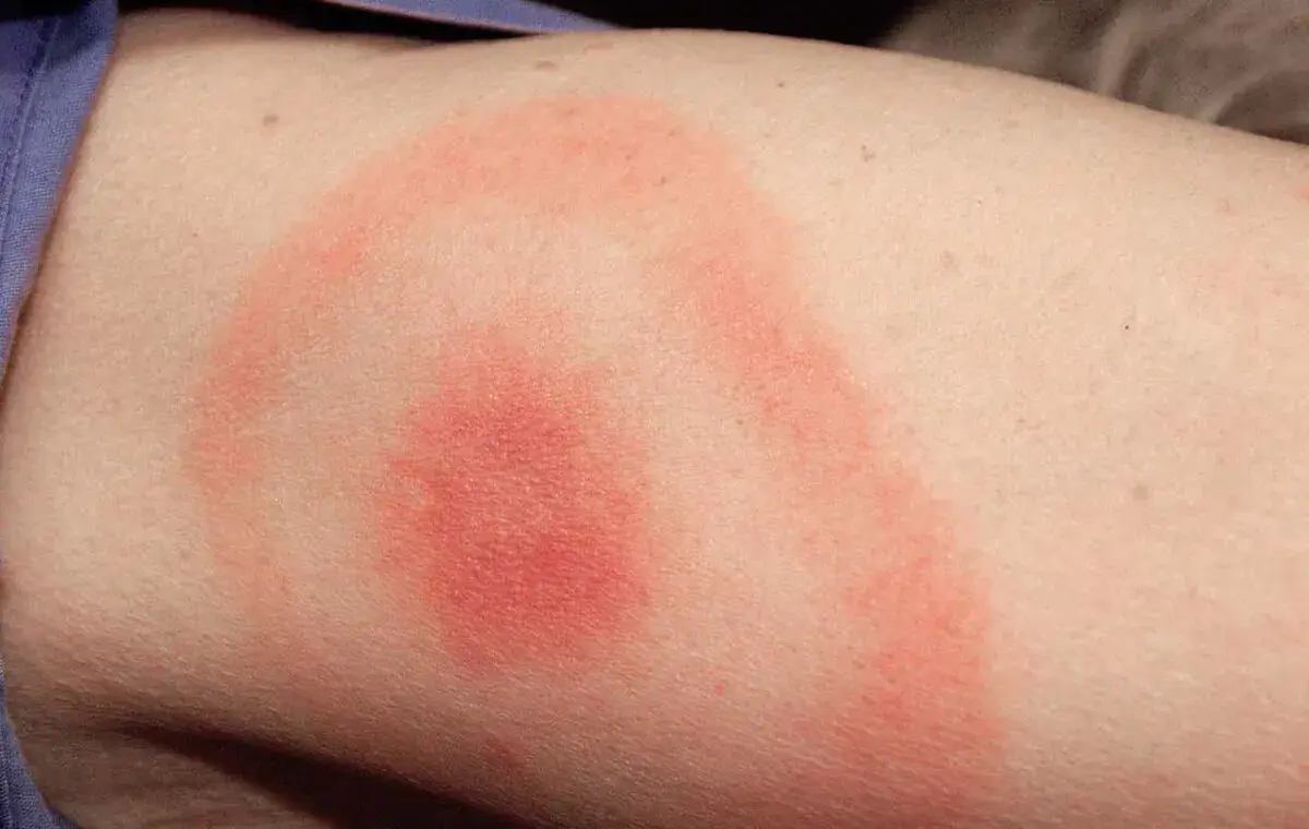 بیماری لایم چگونه تشخیص داده می‌شود؟