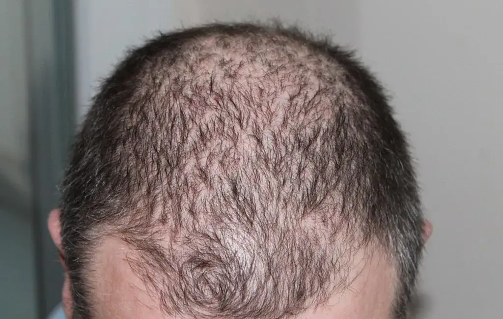 رویش غیرطبیعی در کاشت موی ناموفق