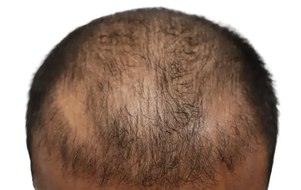 عدم رویش موهای جدید در کاشت موی ناموفق