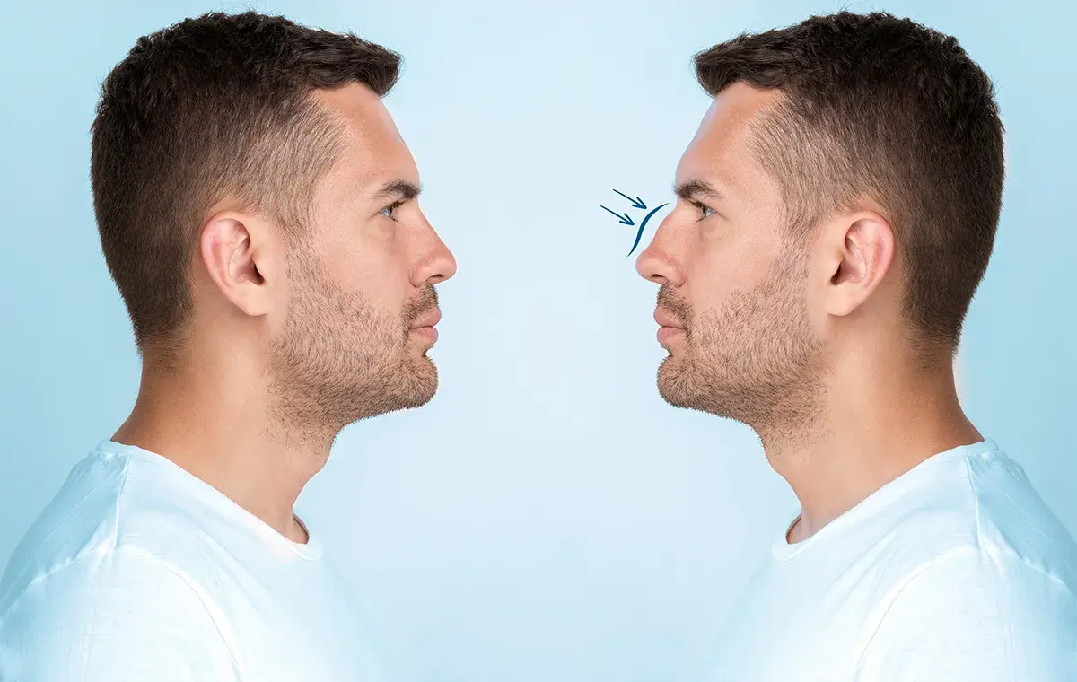 نکروز بینی چیست