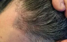 کاشت مو ناموفق