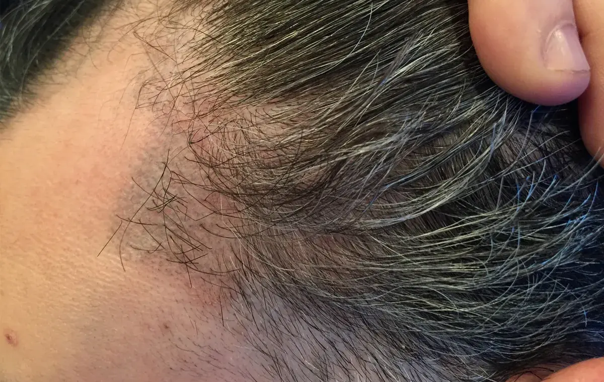 کاشت مو ناموفق