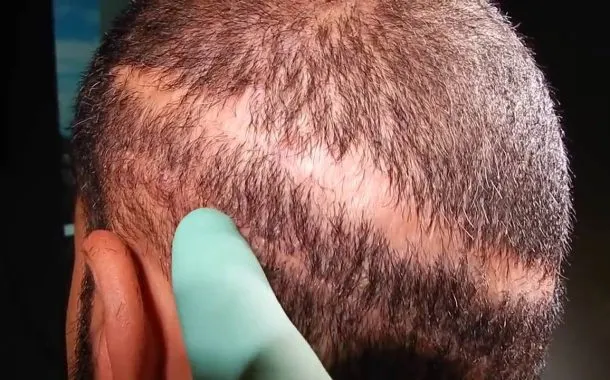 کاشت موی ناموفق نمونه اول