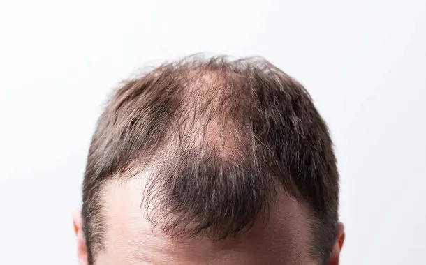 کاشت موی ناموفق نمونه سوم