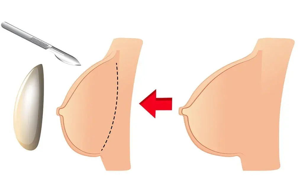 تصویر بعد از عمل ماموپلاستی