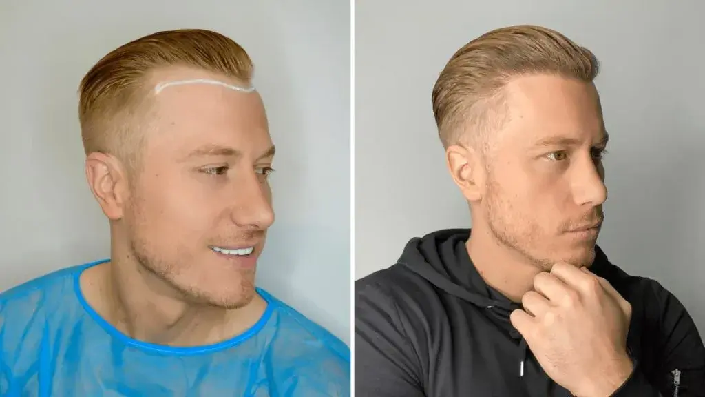 رشد مو پس از پیوند