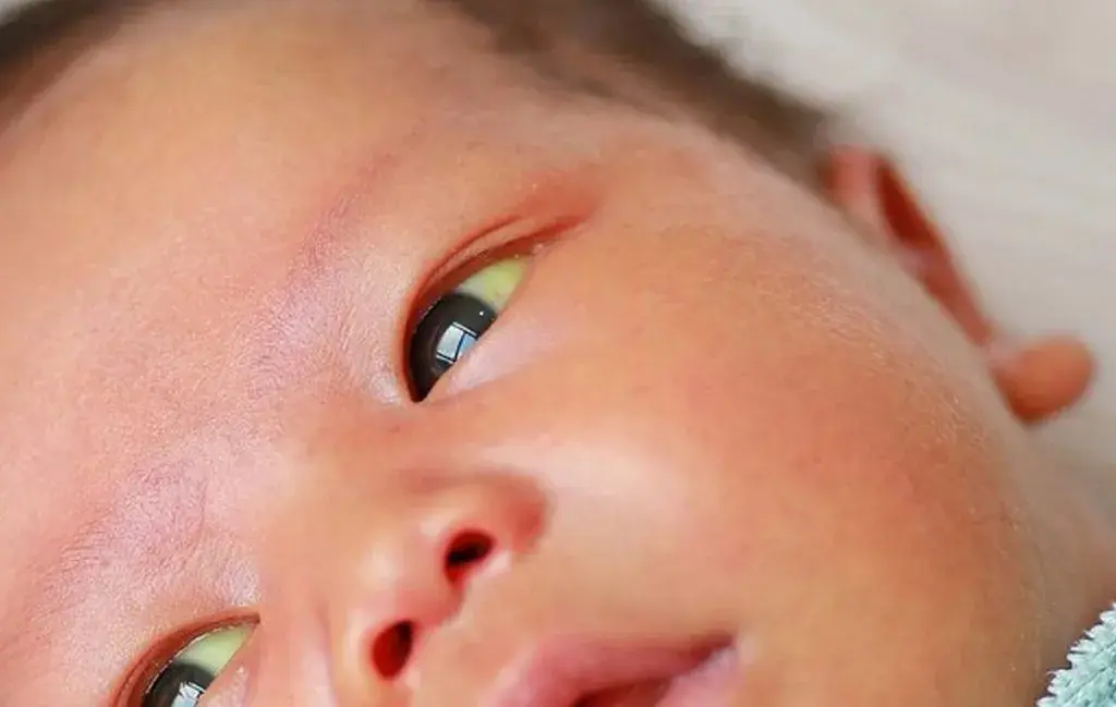 علائم هپاتیت B