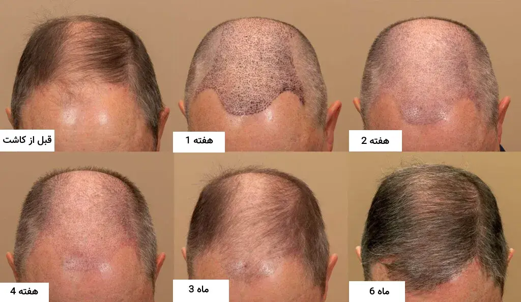 عکس مراحل رشد مو بعد از کاشت