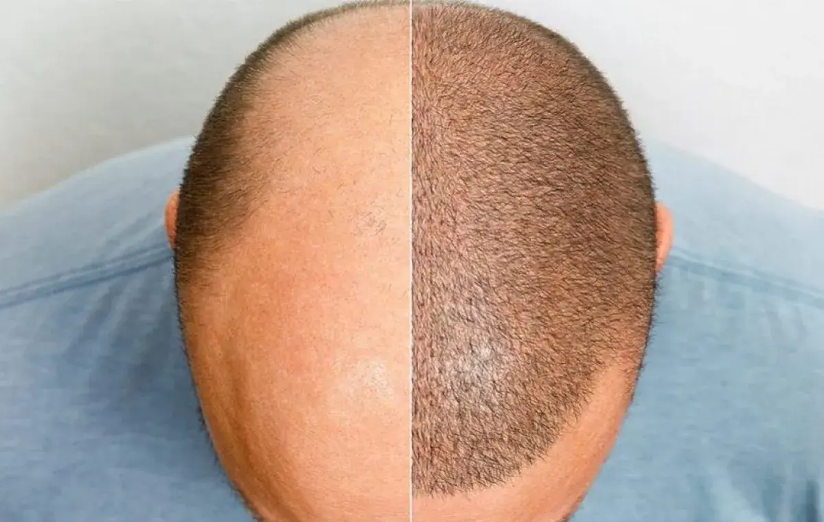 مراحل رشد مو پس از کاشت با تصویر