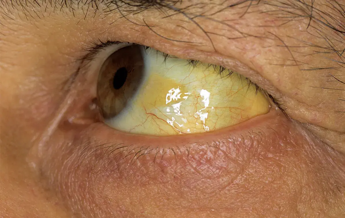 هپایتیت چیست