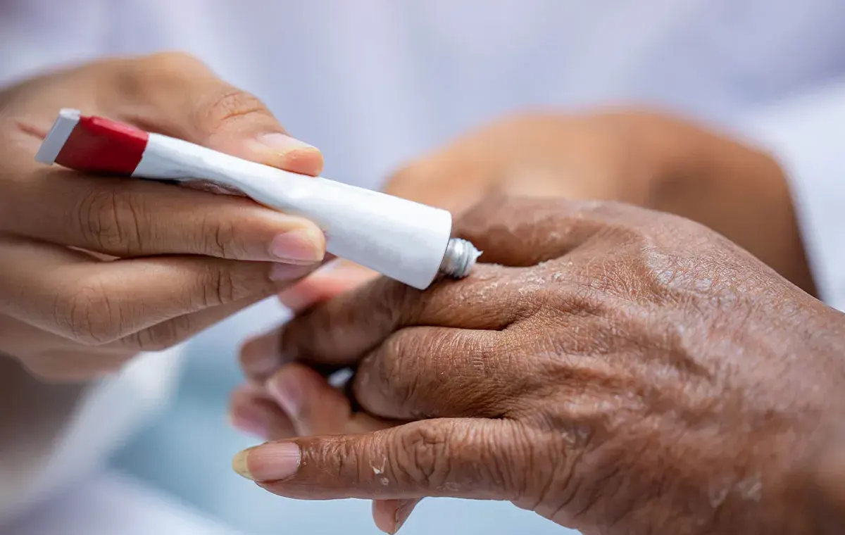 بتامتازون برای اگزما و حساسیت پوستی