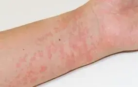 کهیر ناشی از سرما چیست؟