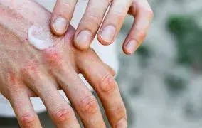 خشکی پوست در زمستان