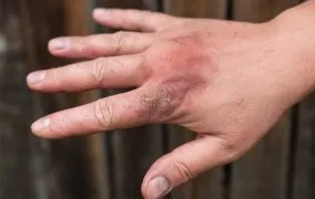 بهترین پماد برای سوختگی با آب جوش