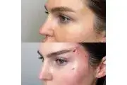 عکس قبل و بعد لیفت ابرو با نخ