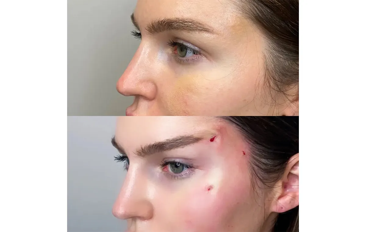 عکس قبل و بعد لیفت ابرو با نخ